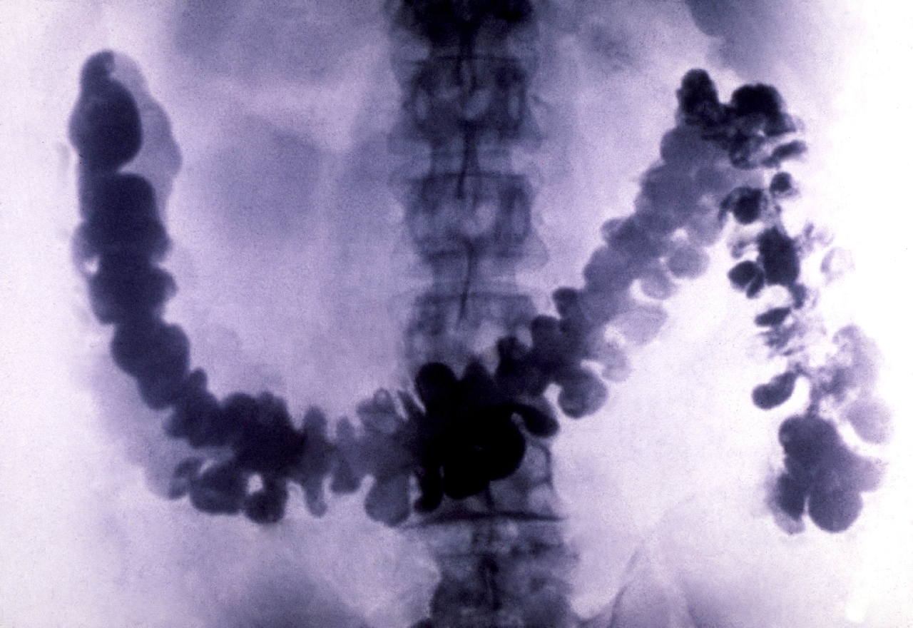 a x-ray of the bowels 